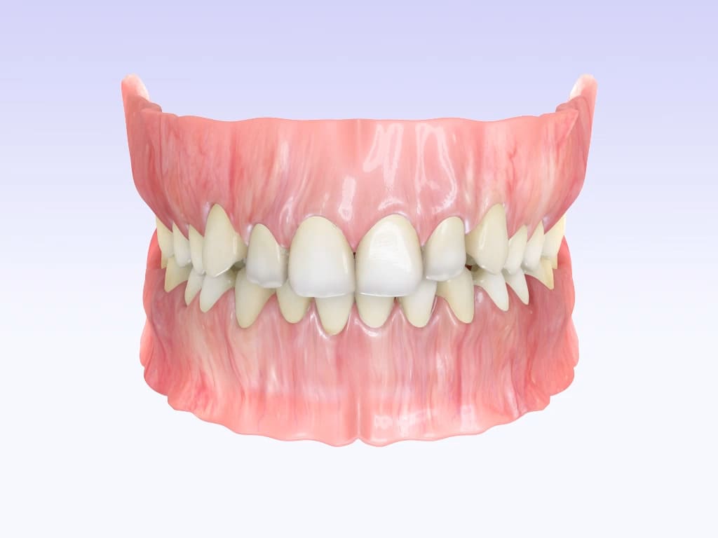 <strong>Aligner Treatment</strong>