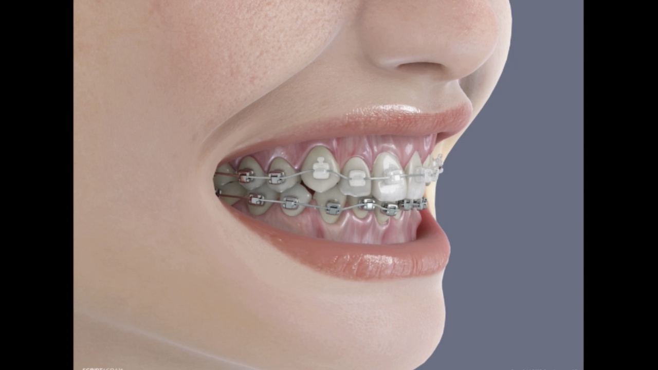 <strong>Brushing, Flossing, and Wax with Braces</strong>