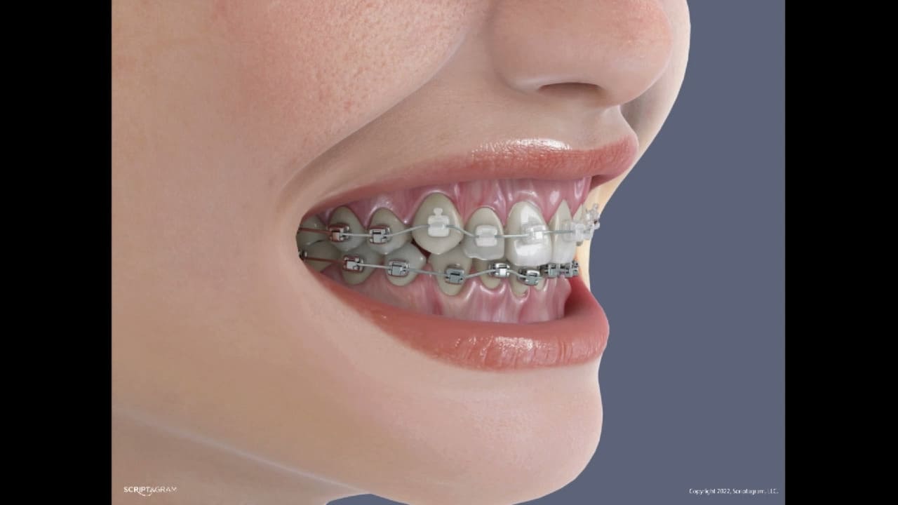<strong>Brushing with Braces (Spanish)</strong>